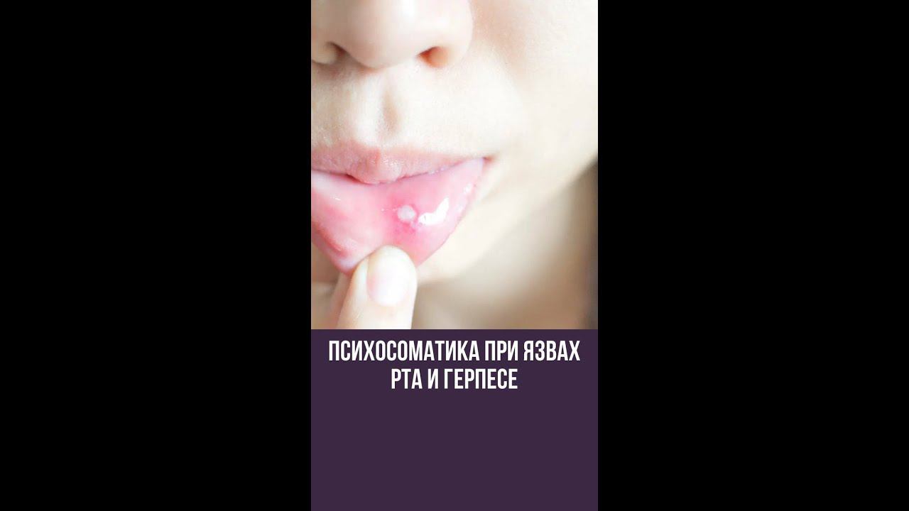 ПСИХОСОМАТИКА ПРИ ЯЗВАХ РТА И ГЕРПЕСЕ