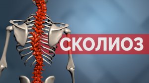 Сколиоз. Что это? Как протестировать?