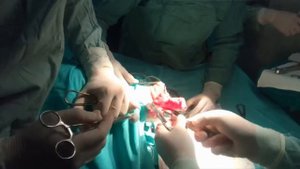 Реампутация ноги 4 см