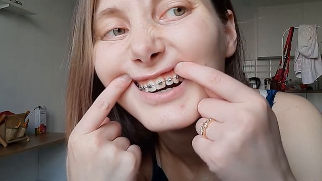 Брекеты 6 месяцев спустя смотреть онлайн