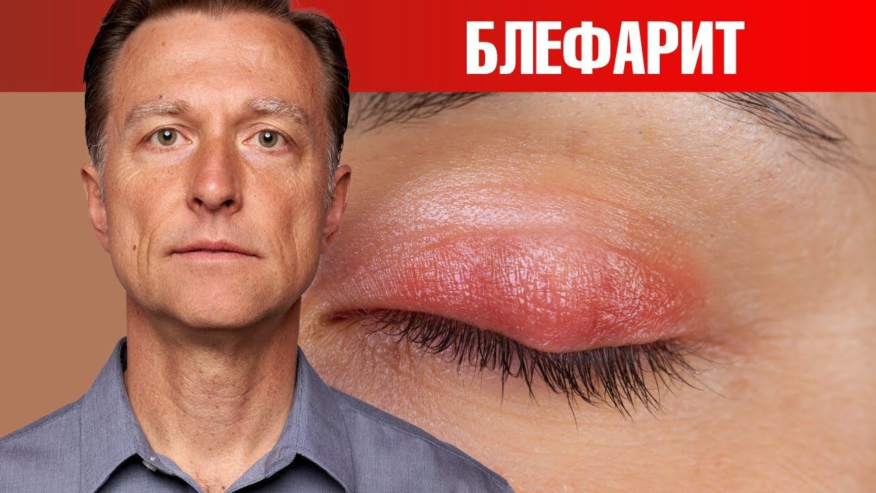 Натуральное средство от воспаления век. 100% эффективно