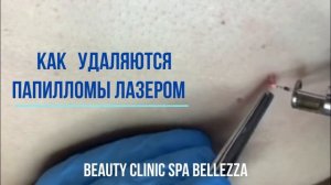 Удаление папиллом лазером