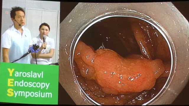 24Live Yutaka Saito LST G ободочной кишки, Эндоскопическое подтверждение инвазивного рака смотреть онлайн
