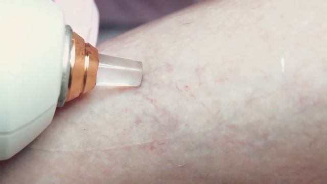 Удаление сосудистых звездочек на аппарате М22 смотреть онлайн