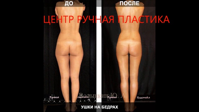 Центр Ручная Пластика ⁄ Коррекция Бёдер Ягодиц  Без Диет и Упражнений