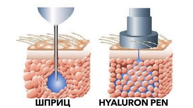 НОВИНКА В КОСМЕТОЛОГИИ! HYALURON PEN! Безыгольное введение филлеров! смотреть онлайн