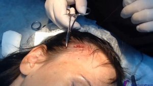 Эндоскопический лифтинг верхней части лица  Проводит доктор Ползиков Владимир Владимирович