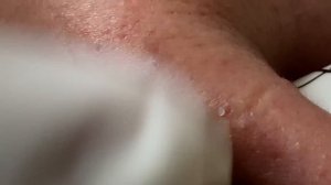 Acne Treatment Huong Da Nang#573 | 2023