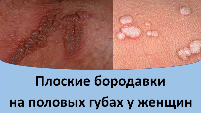 Плоские бородавки на половых губах у женщин