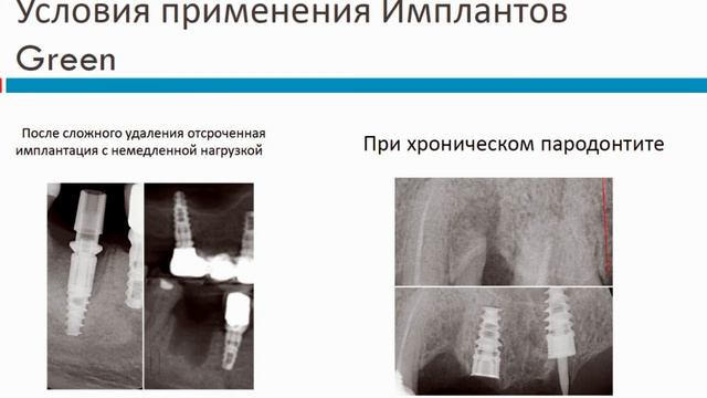 к.м.н. Мухина Екатерина Владимировна о применении системы имплантатов Green Implant