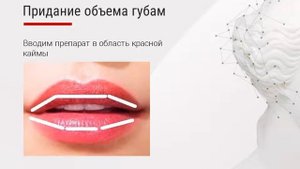 Коррекция губ филлерами Neauvia