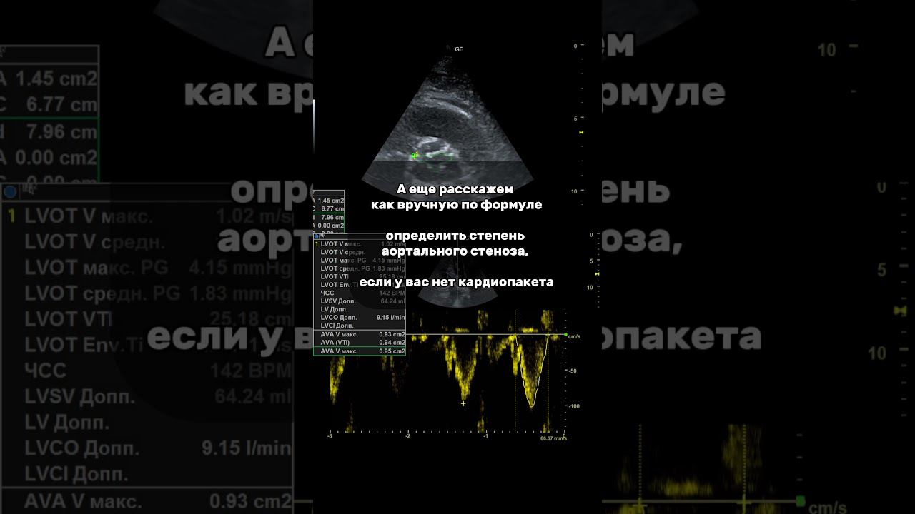 Обучение ЭхоКГ. Урок 7. Аортальный стеноз #узи #узисердца #эхокг #ас #аортальный стеноз #пороксердца