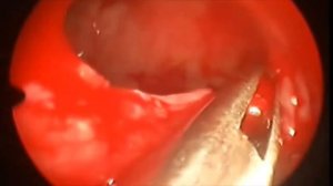 Електрокоагуляция нижних носових раковин