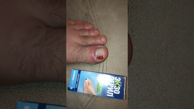 Борьба с грибком ногтя или ОСТОРОЖНО ЭКЗОДЕРИЛ!!!!! АХТУНГ ДЕНЖЕР!!!! смотреть онлайн