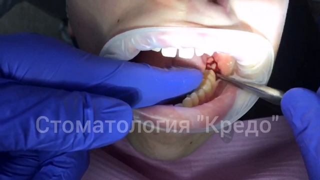 Удаление зуба "мудрости"