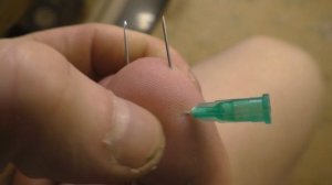 Проколол большой палец ноги буквой "Н"