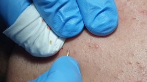 BIG BLACKHEADS EXTRACTIONS on Happy :) #4