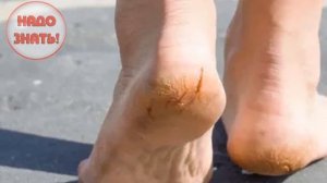 Почему шелушится кожа на пятках?