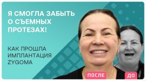 Как прошла имплантация Zygoma: отзыв пациентки