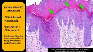 Lichen Simplex Chronicus & Prurigo Nodularis: The "Lichen" Every Pathologist Should Know