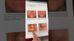 ПЕРИОРАЛЬНЫЙ ДЕРМАТИТ И РОЗАЦЕА - ОДНО И ТОЖЕ?