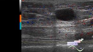 УЗИ мягких тканей - Образования бедра