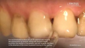 Пескоструйная чистка зубов