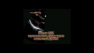 11. Дефект межжелудочковой перегородки у плода (Ventricular Septal Defect in fetus)