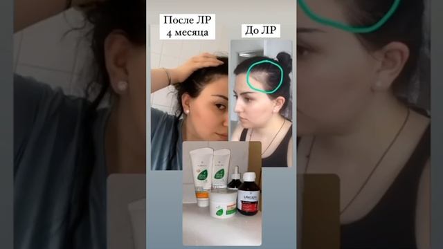 Выпадение #волос #алопеция #здоровье #beauty #германия #алоэ #бадыдляздоровья #жизньбезлекарств
