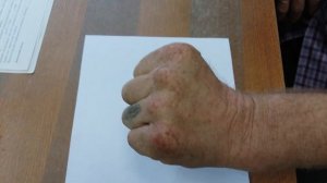 повреждение локтевого нерва