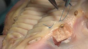 11. 2. Пластика дефекта при хроническом пародонтите