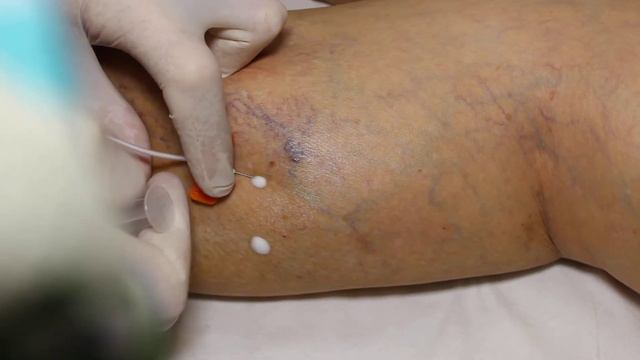 склеротерапия sclerotherapy