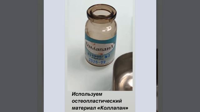 Атравматичное удаление зубов.Сегментирование корней. Консервация лунки.Датский шов.Tooth extraction смотреть онлайн