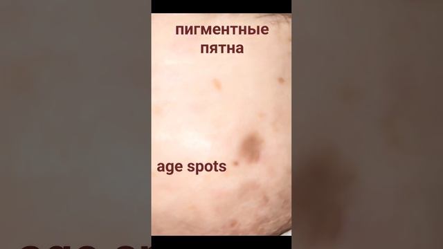 Коричневые пятна на лице. Что с этим делать? #short #пигментация