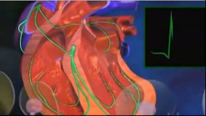 Желудочковая тахикардия