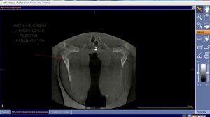 кт придаточных пазух носа .томография черепа