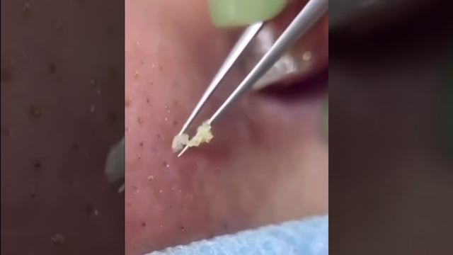 ЧИСТКА ПОР ПИНЦЕТОМ|CLEANING PORES WITH TWEEZERS