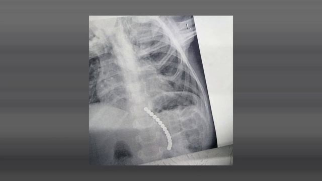 Врачи Оренбурга достали 15 магнитов из желудка 3-летнего ребенка смотреть онлайн