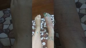 Перелом таранной кости. Разрабатываю ступню! верю что ходить начну скоро!