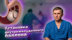 Установка внутрижелудочного баллона