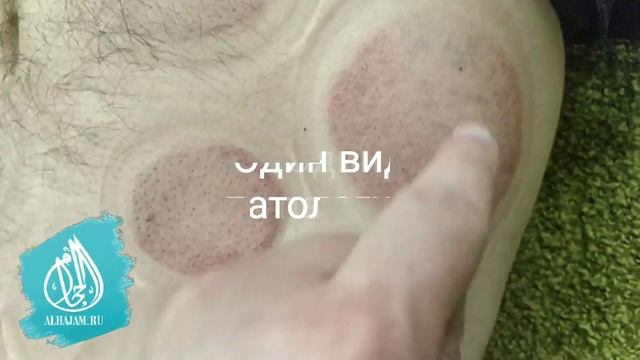 Хиджама сухая Медицинские банки