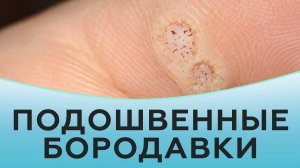 Подошвенные бородавки.