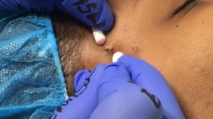 Cyst Removal New Client