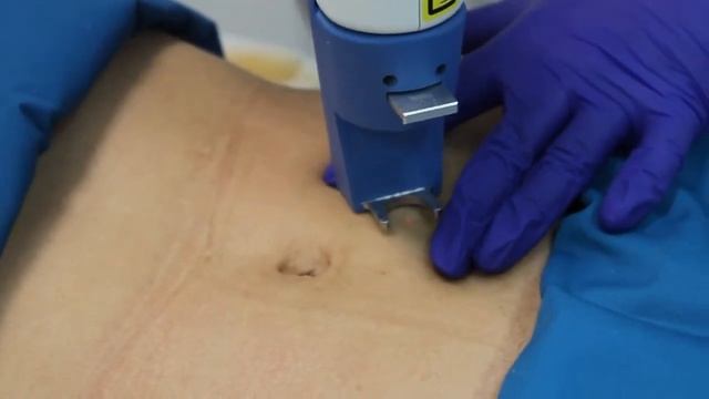 Лазерная эпиляция