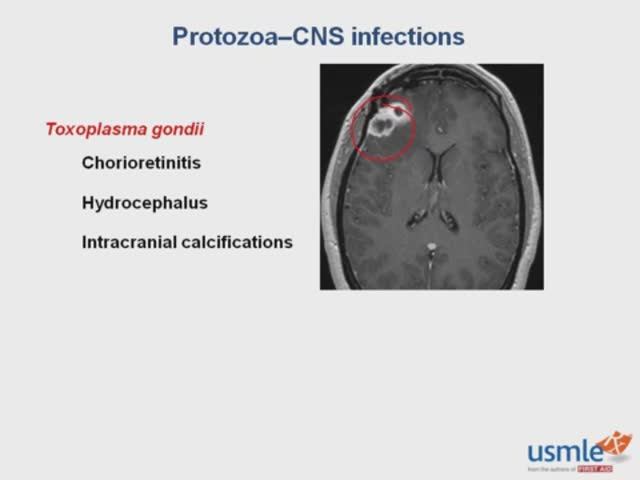 USMLE RX - 7.Микробиология - 5.Паразитология - 6.Простейшие-Инфекции ЦНС