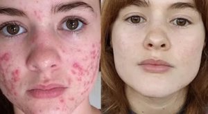 Для Женщины- Как Навсегда Избавиться От Прыщей_Акне