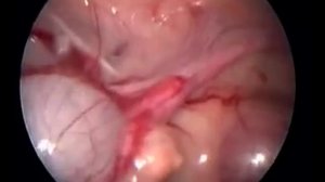 Киста яичника