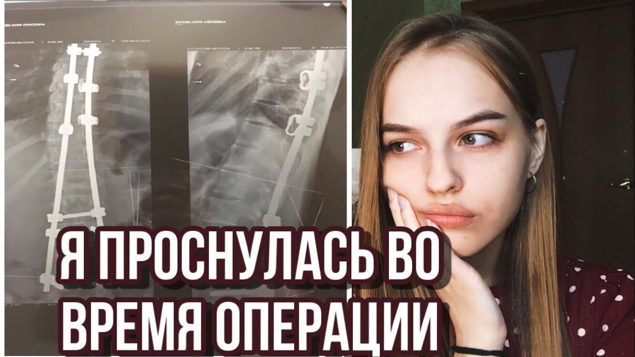 РЕАБИЛИТАЦИЯ после ОПЕРАЦИИ на сколиоз 4 степени/ мой опыт