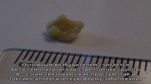 Почему появляются пробки в миндалинах