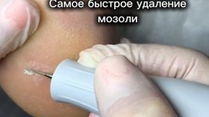Самое быстрое удаление мозоли